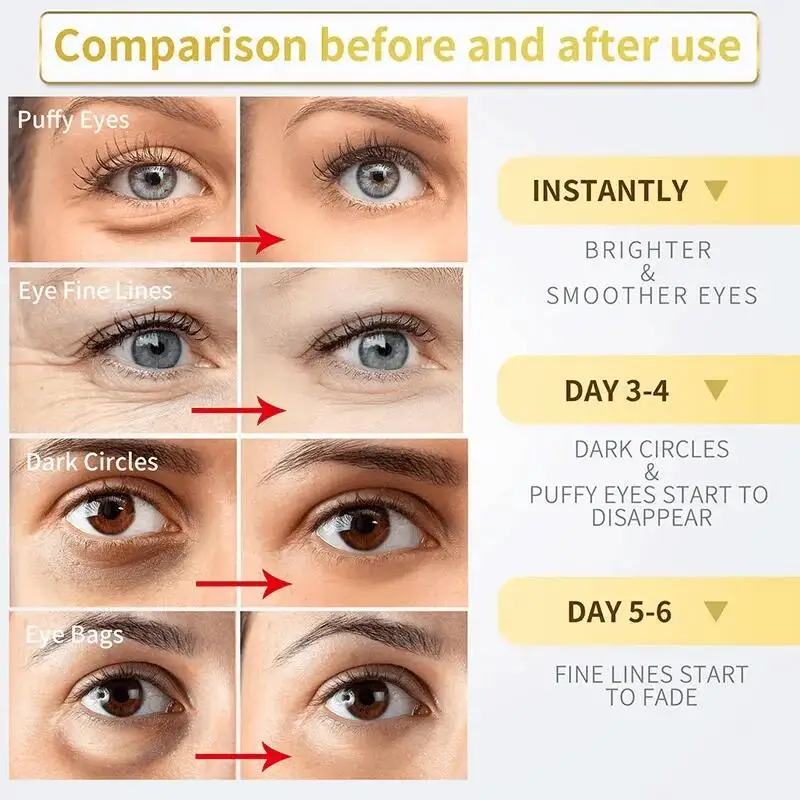 FORT Under Eye Gel Remove Dark Circles Fades Fine Lines Eye Bag Puffiness Anti-aging Tighten Anti Wrinkle Whiten Under Eyes Care 3oml