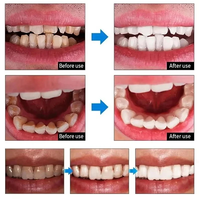 FORT Teeth Whitening Powder | Gentle & Effective Teeth Whitening Powder 100% Natural Strong Formula Dental Whitening Cleaning Powder | 50ml