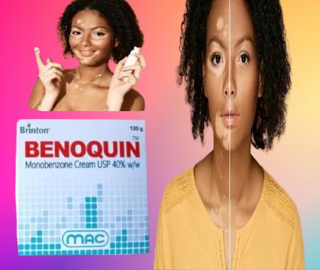 Benoquin Monobenzone Cream New In Pakistan | Daraz.pk
