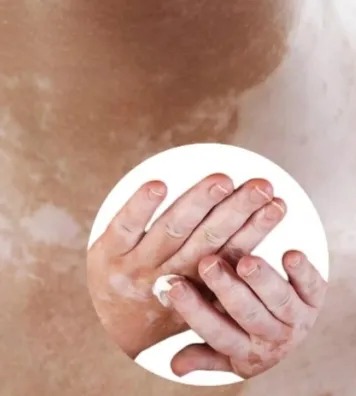 Vitiligo Health Cream | Daily Skin Care Cream | Moisturizing & Nourishing Formula | For Dry & Sensitive Skin | 20g