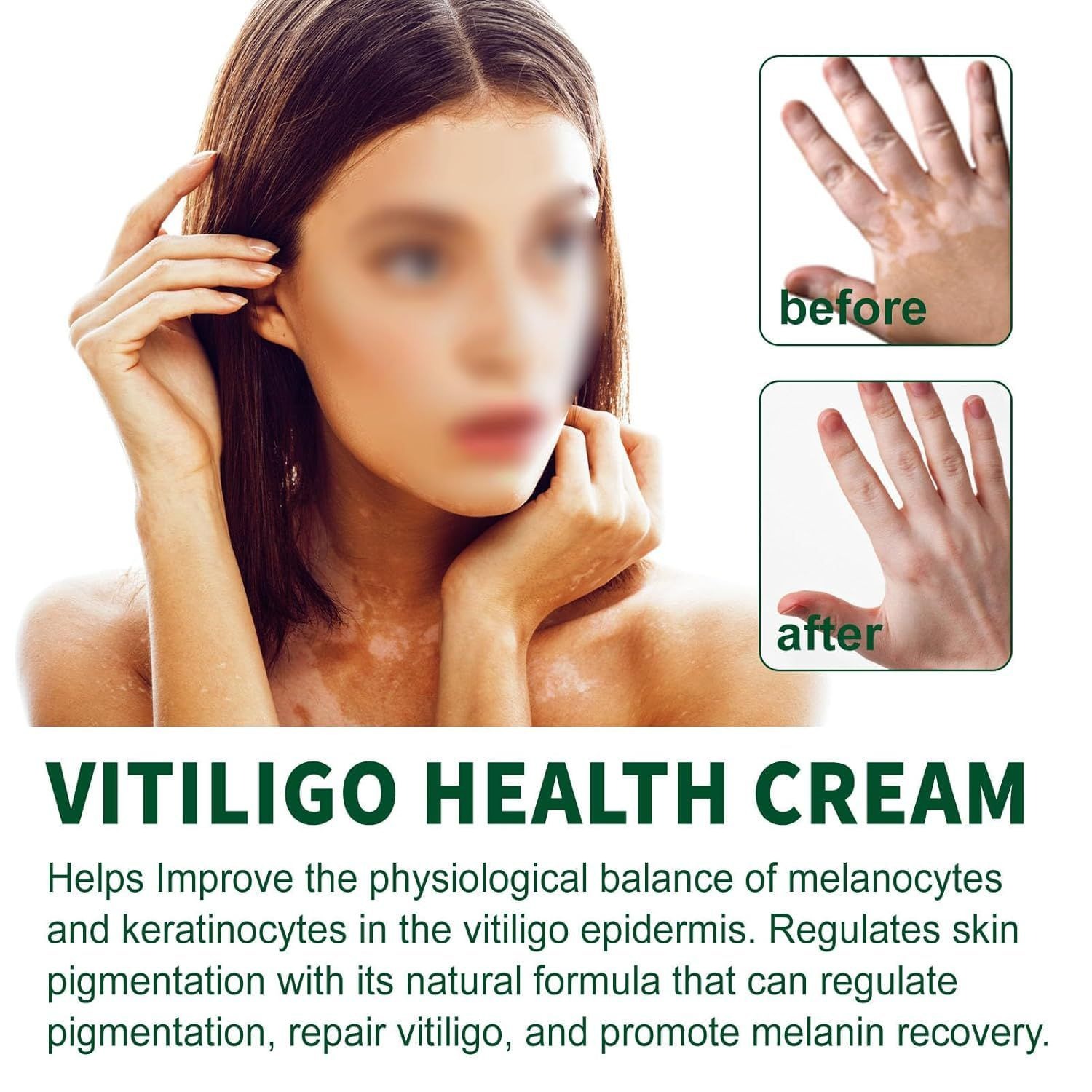 Vitiligo Health Cream | Daily Skin Care Cream | Moisturizing & Nourishing Formula | For Dry & Sensitive Skin | 20g