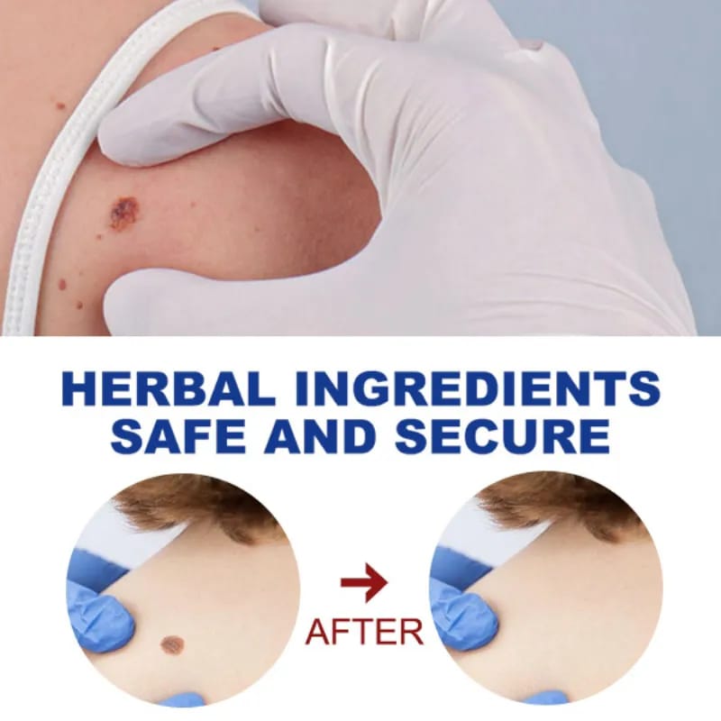Removal Of Warts Liquid Pen Woman Skin Care Removing Against Moles Patch Remove Black Dot Emulsion
