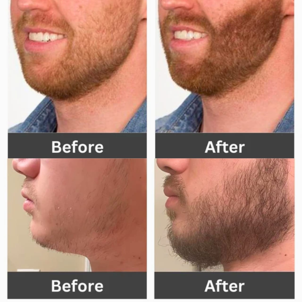 Hair & Beard Spray - Minoxin Spray - Minoxidil Spray - Minoxin Beard Growth Oil - Hair Fall Treatment Solution