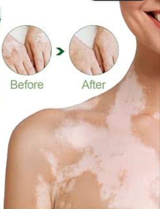 Vitiligo Health Cream | Daily Skin Care Cream | Moisturizing & Nourishing Formula | For Dry & Sensitive Skin | 20g