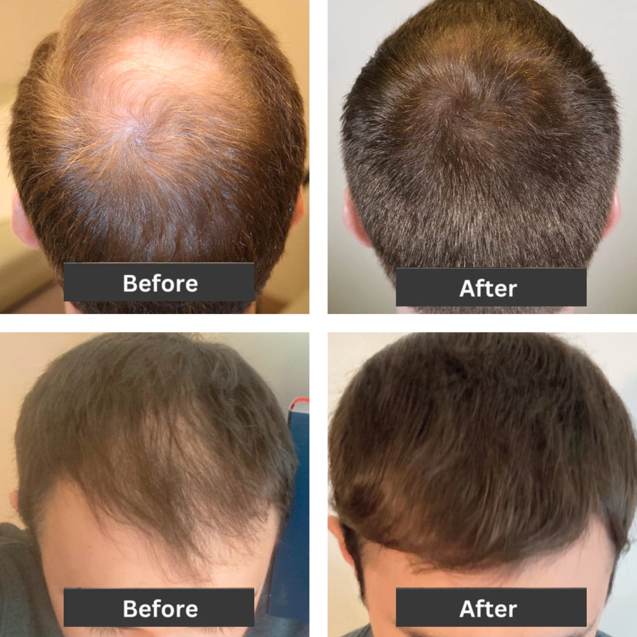 Hair & Beard Spray - Minoxin Spray - Minoxidil Spray - Minoxin Beard Growth Oil - Hair Fall Treatment Solution