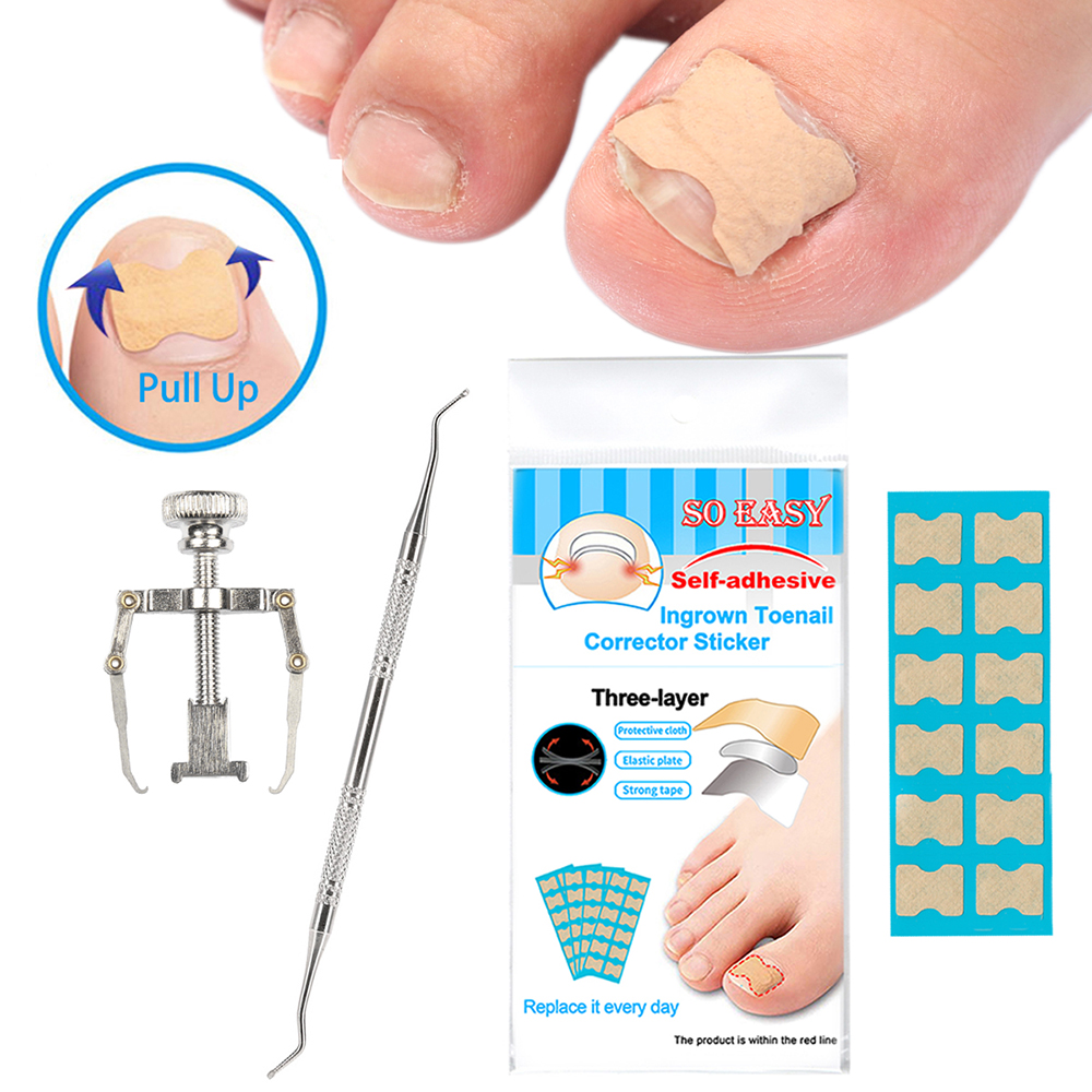 Ingrown Nail Correction Kit Ingrown Toenail Stickers Toe Nail Clamp Lifter Straightening Treatment Recover Corrector Toe Nail Fingernail Care Tool Buy Online At Best Prices In Pakistan Daraz Pk