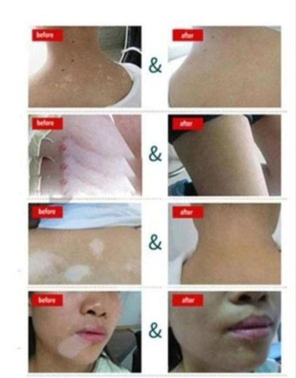 Vitiligo Health Cream | Daily Skin Care Cream | Moisturizing & Nourishing Formula | For Dry & Sensitive Skin | 20g