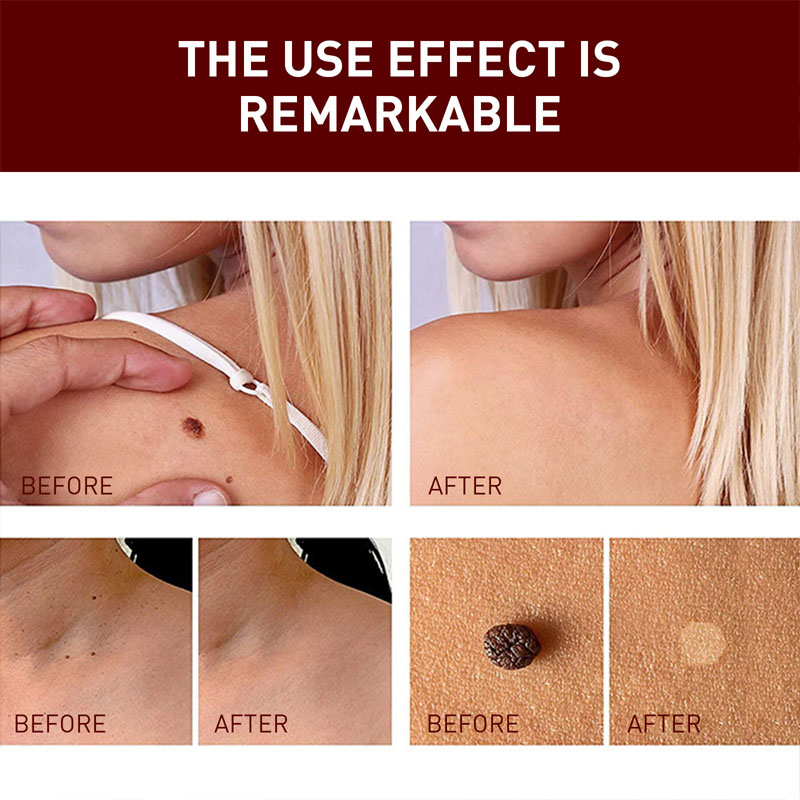 Removal Of Warts Liquid Pen Woman Skin Care Removing Against Moles Patch Remove Black Dot Emulsion