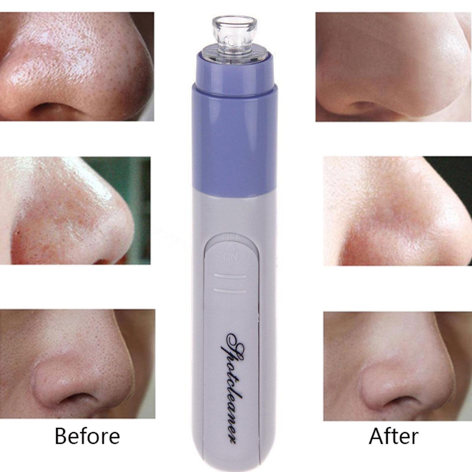 in  blackhead remover