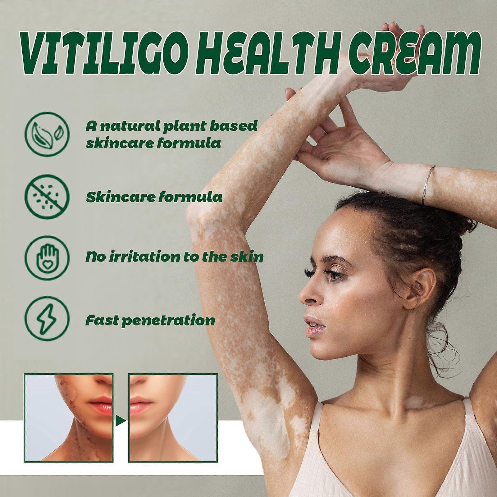 Vitiligo Health Cream | Daily Skin Care Cream | Moisturizing & Nourishing Formula | For Dry & Sensitive Skin | 20g