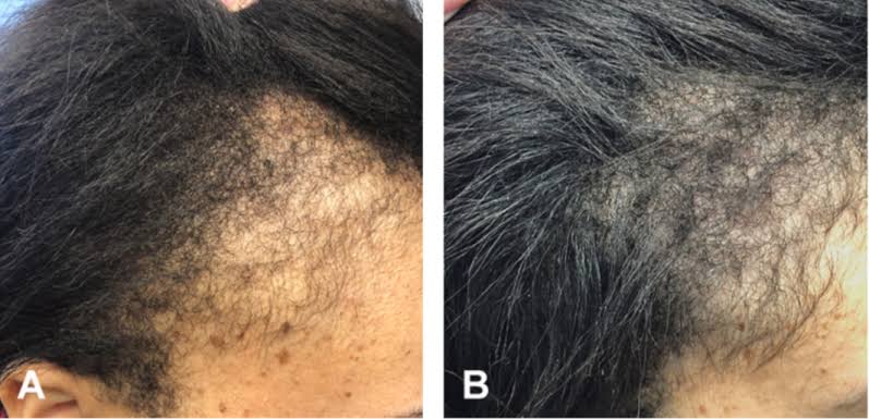 Hair & Beard Spray - Minoxin Spray - Minoxidil Spray - Minoxin Beard Growth Oil - Hair Fall Treatment Solution