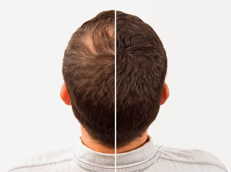 Volume Vault USA Hair Building Fibers 12g All Colours | Best Alternative of Toppik and Caboki | King Hair Fibers