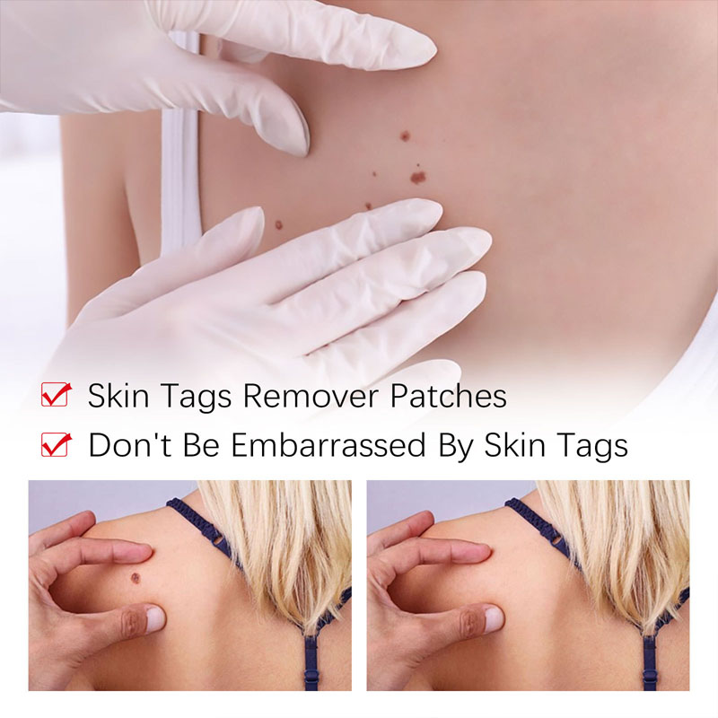 Removal Of Warts Liquid Pen Woman Skin Care Removing Against Moles Patch Remove Black Dot Emulsion