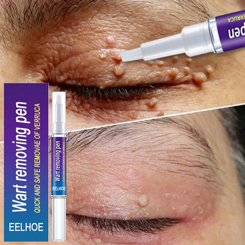 Removal Of Warts Liquid Pen Woman Skin Care Removing Against Moles Patch Remove Black Dot Emulsion