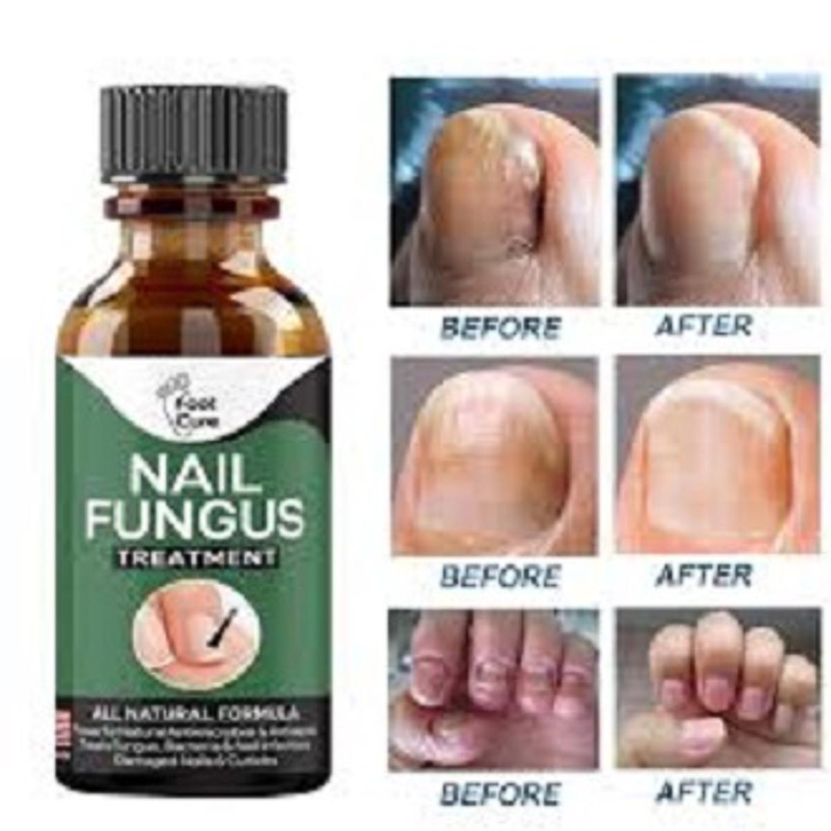Fast Nail Fungal Treatments Oil Nail Repair Essences Serum Care Treatments Foot Nail Fungus Removal Gel Paronychia Onychomycosis