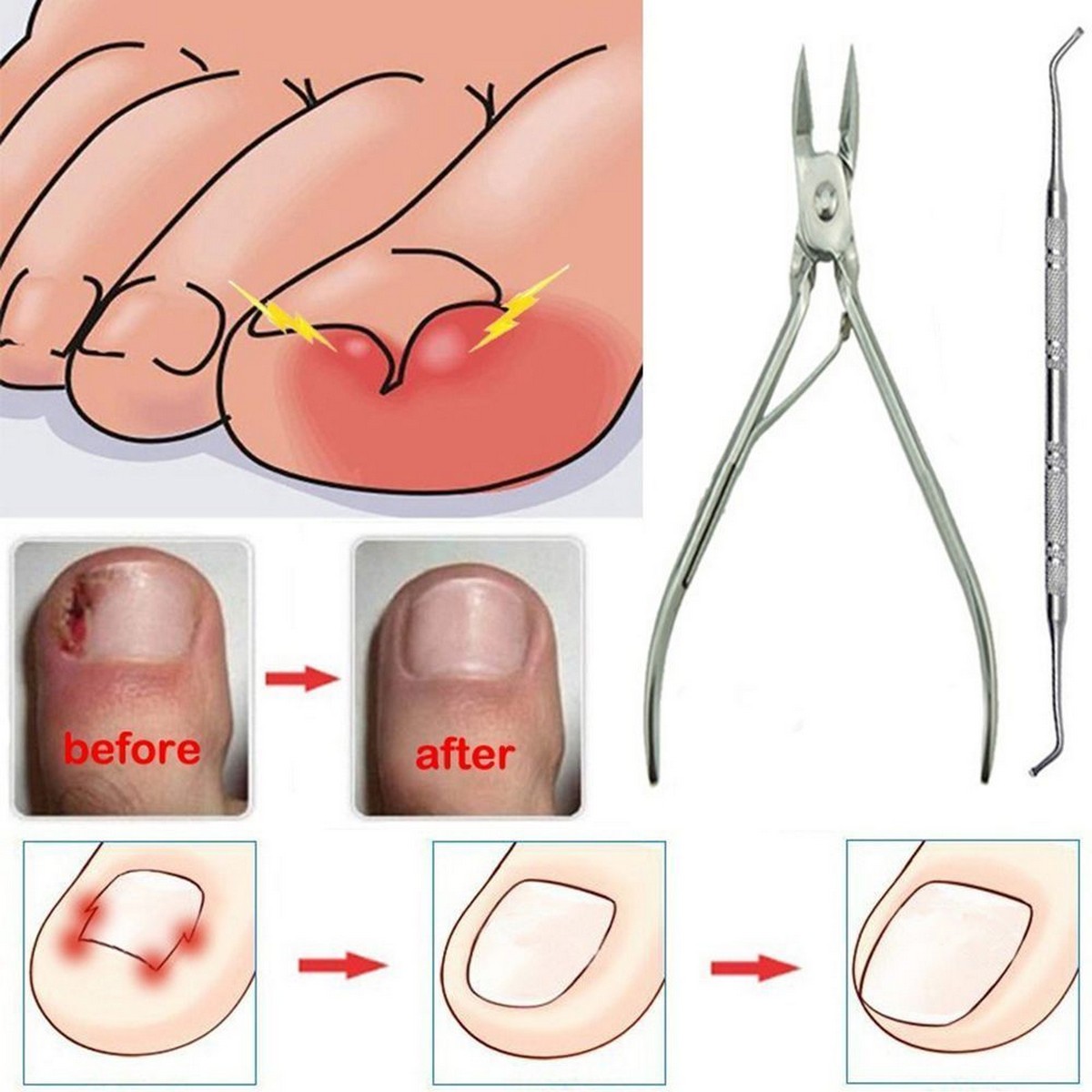 Ingrown Toenail Surgery PostOp Care Tdhurst (w/ Pictures) 50pcs Set