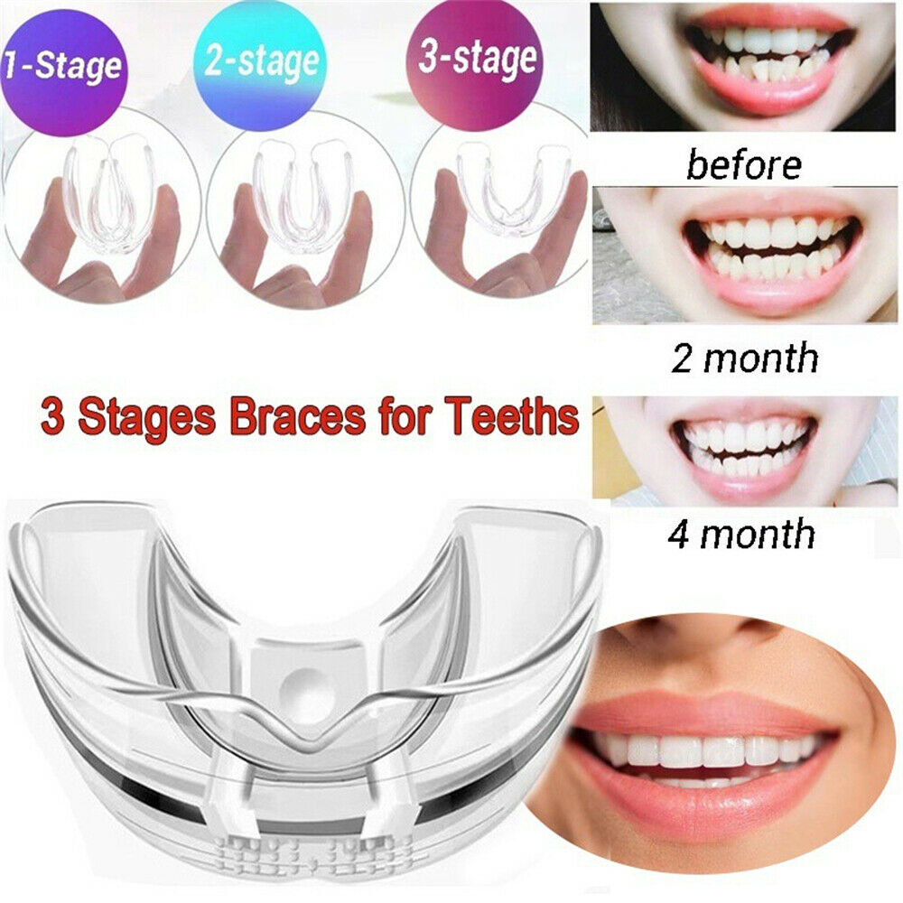 Teeth Braces Price In Pakistan 