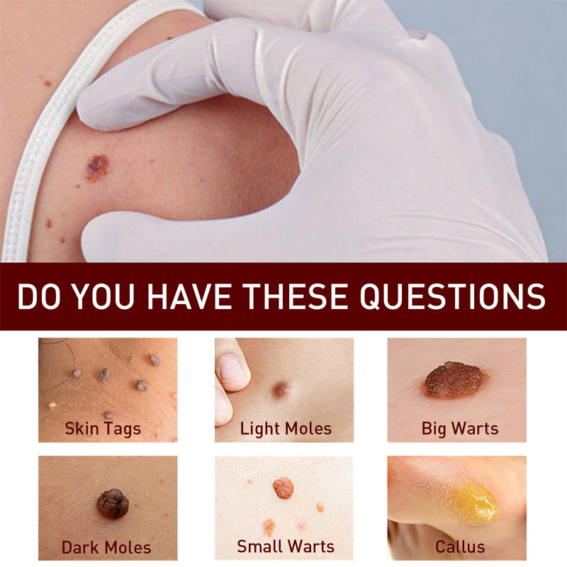 Removal Of Warts Liquid Pen Woman Skin Care Removing Against Moles Patch Remove Black Dot Emulsion