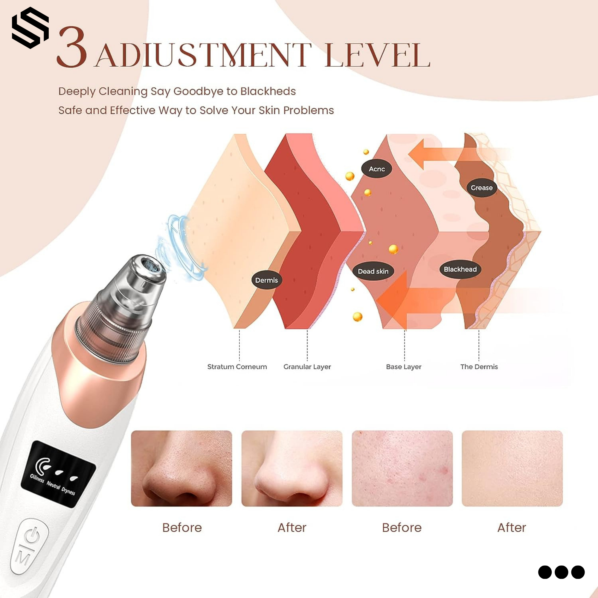 Blackhead Removal Machine Derma Suction 5 In 1 Black Head Remover Machine Acne Pimple Pore Cleaner Vacuum Tool Rechargeable Machine Oil Remover Multi-Functional Skin Care Tools Facial Beauty Device Whitehead Remover Deep face dust Cleaner