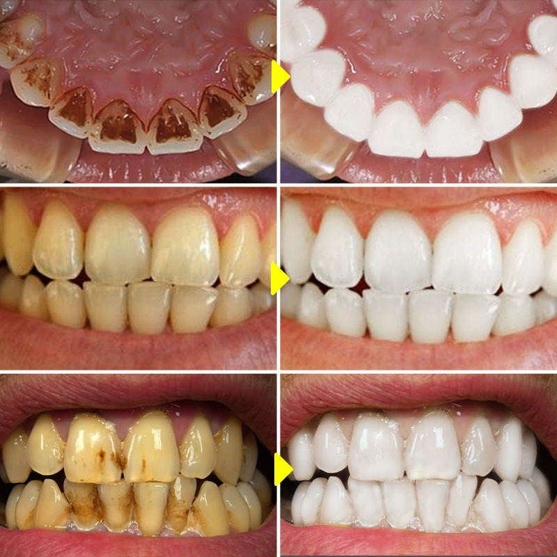 Teeth Cleaning Esence Naturally brighting Liquid | Teeth Whitening Powder Clean Oral Hygiene Whiten Teeth Remove Plaque Stains Fresh Breath Oral Hygiene Dental Tools 10ML