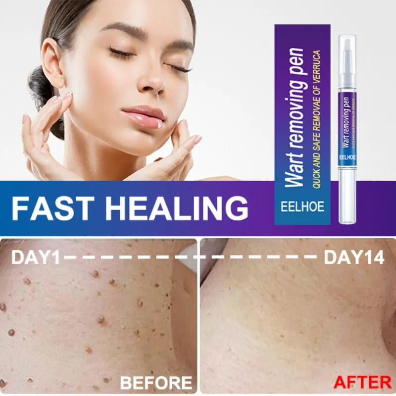 Skin Tag, Eye Wart & Mole Remover Pen – Women’s Skin Care Tool for Removing Moles, Pimples, Black Dots & Skin Blemishes – Safe & Effective Spot Removal Treatment