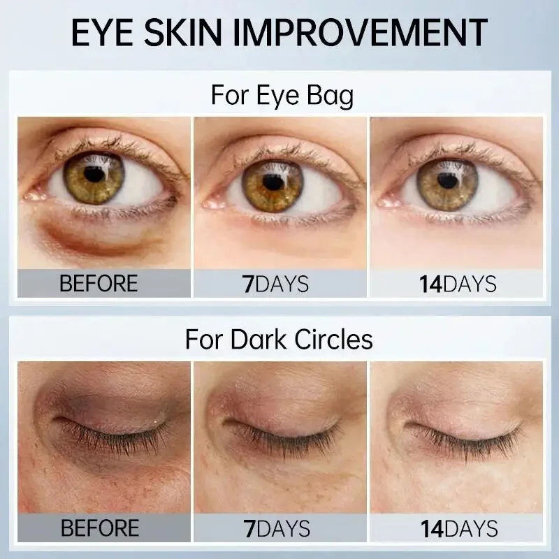 FORT Under Eye Gel Remove Dark Circles Fades Fine Lines Eye Bag Puffiness Anti-aging Tighten Anti Wrinkle Whiten Under Eyes Care 3oml
