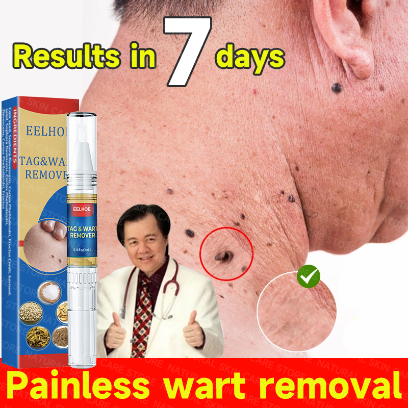 Skin Tag Wart Mole Remover Pen