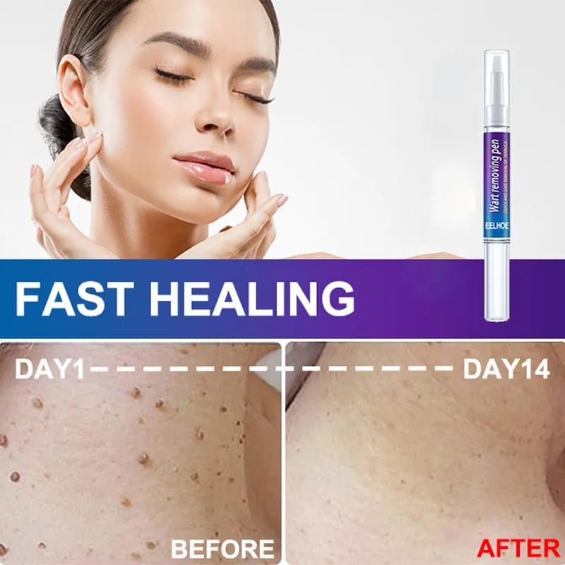 Skin Tag, Eye Wart & Mole Remover Pen – Women’s Skin Care Tool for Removing Moles, Pimples, Black Dots & Skin Blemishes – Safe & Effective Spot Removal Treatment